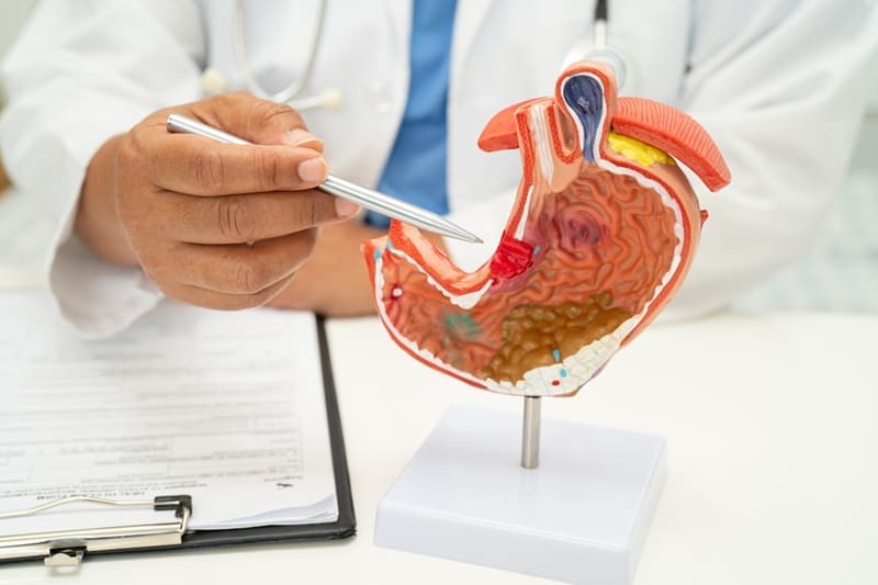 Patología por enfermedad de reflujo gastroesofágico y hernia hiatal en Puebla